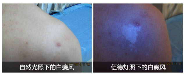 盐城白癜风患者在工作时需要注意哪些方面？